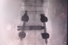 Artrodesi Vertebrale