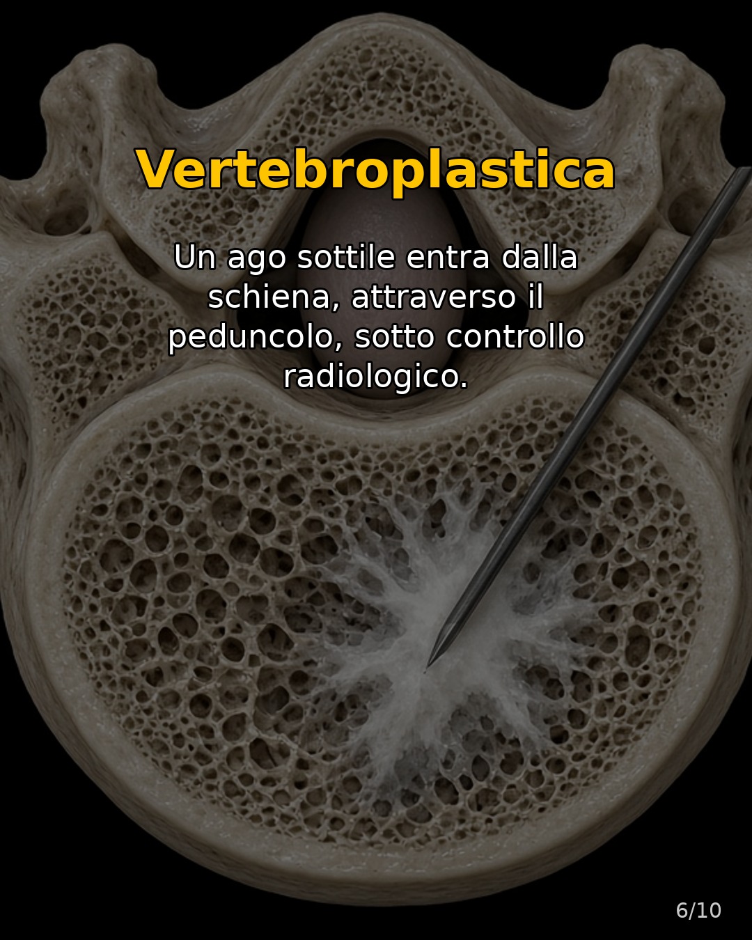 Infografica: vertebroplastica: ago attraverso il peduncolo
