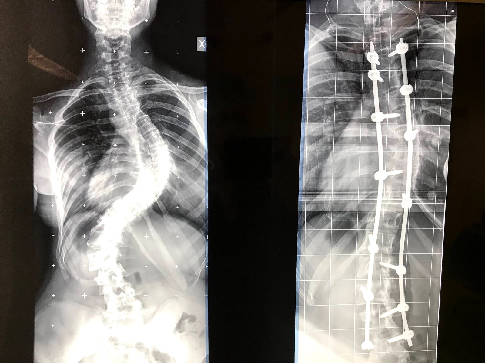 Scoliosi dell'adolescente: radiografia prima e dopo l'artrodesi vertebrale posteriore con viti peduncolari e barre