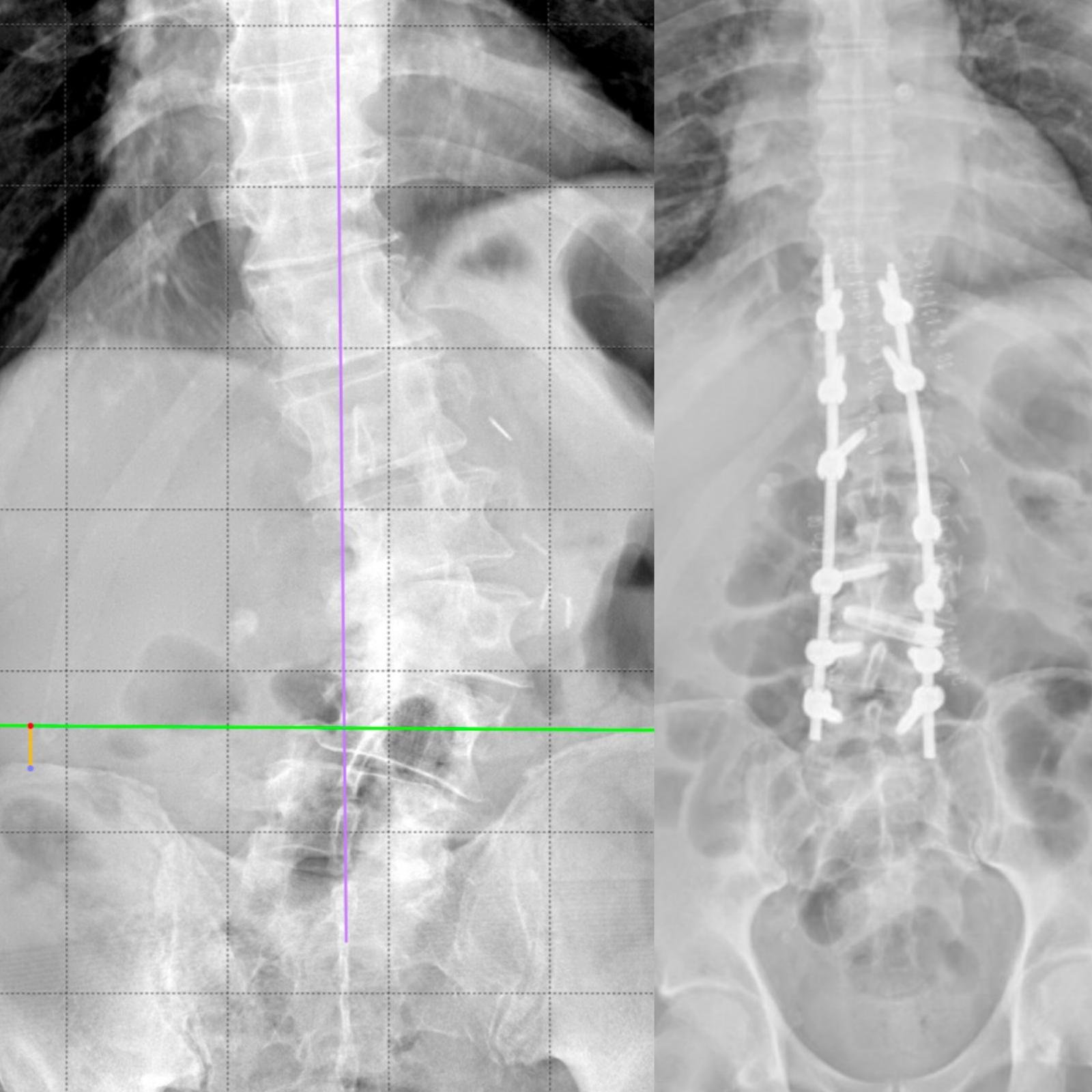 Scoliosi lombare degenerativa: radiografia prima e dopo l'artrodesi